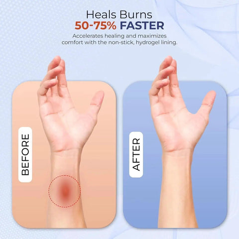 Before and after healing results using Complete 25 Piece Burn First Aid Kit With Hydrogel Dressings and Burn Gel for fast relief.