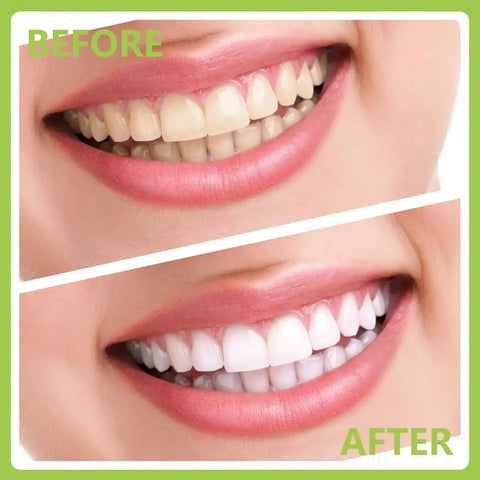Comparison of teeth before and after using Pro At Home Dental Cleaning Kit With Stainless Steel Dental Pick And Tartar Remover.