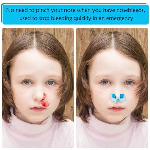 Child with nosebleed and 16 Piece Nose Clip Set For Nosebleed Prevention Epistaxis Stopper Nasal Clip Foam Plastic Stoppers For Adults.