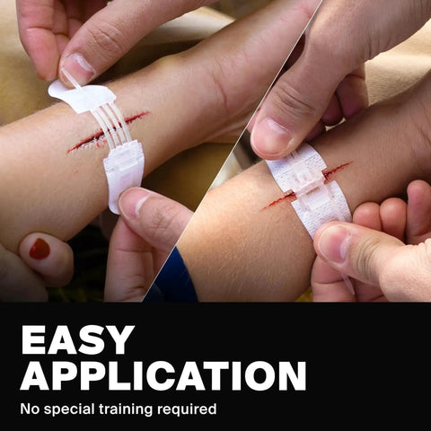 Hands applying Zip Stitch Wound Closure Strips No Stitches Needed Quick Laceration Repair In First Aid Kit for pain-free healing