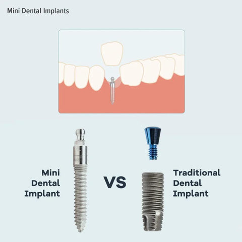 Comparison of mini dental implant and traditional dental implant with diagram of implant in jawbone.